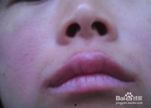 吃蜜瓜嘴唇过敏,揭秘嘴唇过敏背后的真相